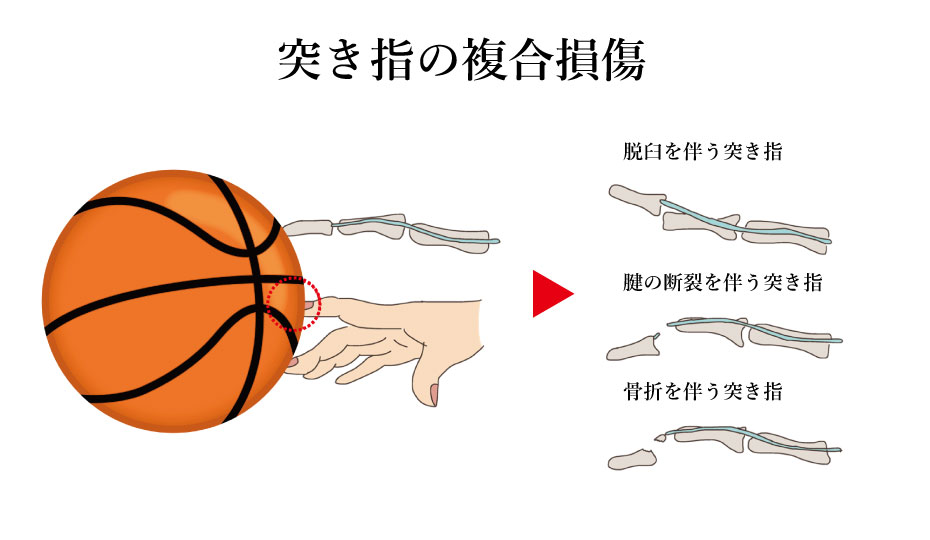 突き指の複合損傷・突き指テーピング治し方。砺波・南砺市のスポーツ・ケガ・交通事故治療 山下接骨院のちょっとためになる接骨院のお話。